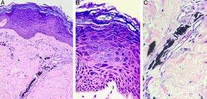 Exame histopatológico do paciente 2, (Hematoxilina & eosina). Em A (aumento de 200×) é evidenciada epiderme hiperceratótica com presença de ceratinócitos balonizados na superfície epidérmica. Na derme há depósito de pigmento preto exógeno ao redor dos vasos. Em B (aumento de 400×) ficam evidentes o polimorfismo e a hipercromia nuclear, além do citoplasma amplo e basofílico dos ceratinócitos, caracteriza‐se o efeito citopático do HPV. Em C (aumento de 400×) nota‐se com detalhe o pigmento preto da tatuagem depositado ao redor dos vasos.
