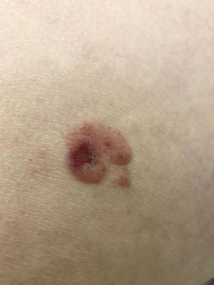 Placa rósea levemente elevada com limites irregulares, porém evidentes e com pequena área de exulceração localizada na região glútea.