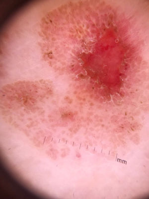 Imagem panorâmica da dermatoscopia mostra várias estruturas arredondadas, marrons e bem delimitadas, circundadas por vasos em ponto. Área exulcerada pode ser vista.