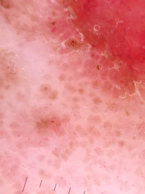 Detalhe das mesmas estruturas na dermatoscopia.