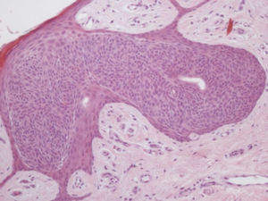 Proliferação intraepitelial bem circunscrita de células arredondadas e basofílicas (Hematoxilina & eosina 200×).