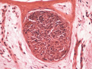 Ninho de células basaloides com quantidade considerável de melanina. Esse fenômeno é observado na dermatoscopia como as áreas marrons (Fontana Masson 200×).