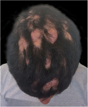 Couro cabeludo com circunvoluções cutâneas e nódulos de consistência amolecida com alopecia sobre suas superfícies.