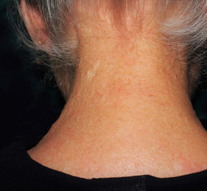 Múltiplas pápulas esbranquiçadas na região cervical posterior.