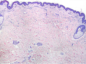 Elastose solar discreta e espessamento dos feixes de colagéno na derme reticular superficial e média (Hematoxilina & eosina, 40×).