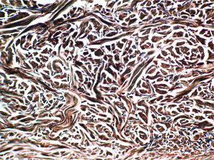 Espessamento dos feixes de colágeno e espessamento grosseiro multifocal das fibras elásticas (Verhoeff, 200×).
