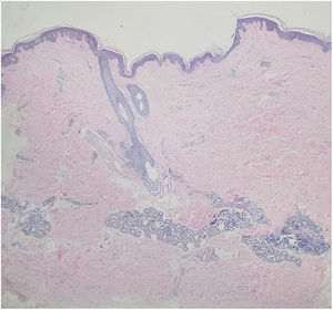 Epiderme normal com pigmentação aumentada da camada basal, com colágeno dérmico mais compacto e infiltração linfocitária perivascular de pequeno grau na derme superior (Hematoxilina & eosina, 40×).