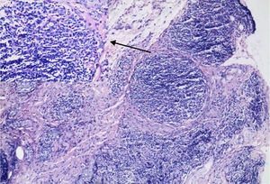 Infiltrado linfocítico nodular com centros germinativos na derme e tecido subcutâneo e centros germinativos reacionais circundados por pequenos linfócitos maduros e eosinófilos (seta) (Hematoxilina & eosina, 100×).
