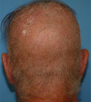 Comprometimento extenso do couro cabeludo, com numerosas pápulas foliculares hiperqueratóticas esbranquiçadas e pontiagudas, além de alopecia.