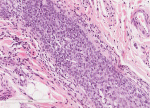 Biópsia do couro cabeludo: infiltrado de linfócitos de pequeno a médio porte com atipia de pequeno grau, ao redor e dentro do epitélio folicular. Não foi observada mucinose folicular (Hematoxilina & eosina, 20×).