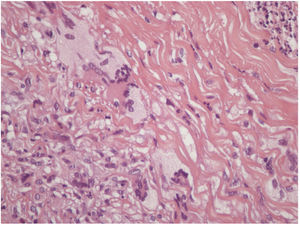 Biópsia de pele. Xantogranuloma necrobiótico. Presença de célula gigante e necrobiose do colágeno.