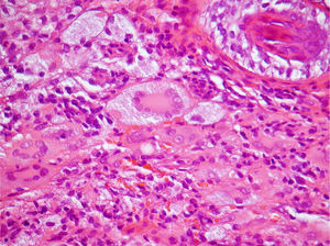 Infiltração circunscrita da derme por histiócitos xantomizados e células gigantes multinucleadas de Touton (Hematoxilina & eosina, 400×).