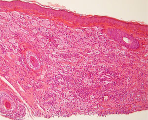 Proliferação histiocitária difusa na derme superficial e profunda associada com infiltrado linfocitário e com células gigantes multinucleadas de Touton (Hematoxilina & eosina, 100×).