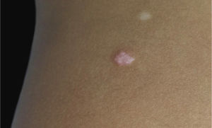 Pápula de coloração rósea em flanco esquerdo.