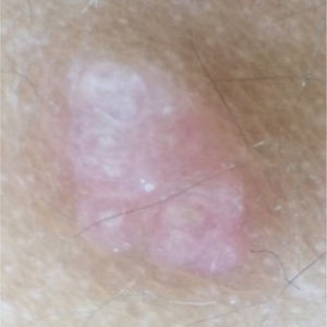 Exame dermatoscópico evidencia estruturas arredondadas de coloração amarelo‐esbranquiçada separadas por estruturas lineares esbranquiçadas em um fundo eritematoso.