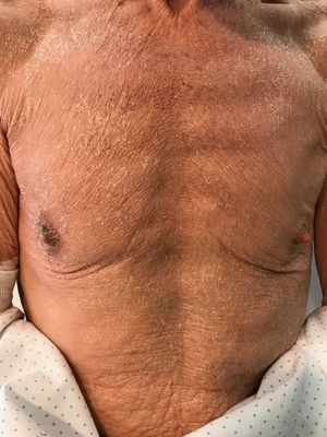 Erupção eritematosa com descamação fina no tronco na apresentação inicial.