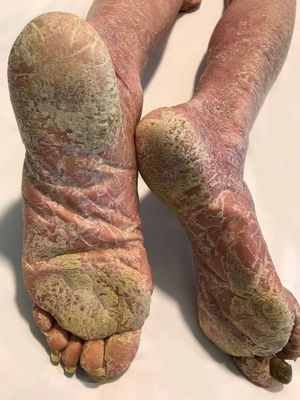 Eritema bilateral da perna e ceratodermia plantar.