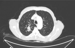 Achados da tomografia computadorizada: Lesão nodular de 22×34mm, com bordas espiculadas no lobo superior direito, com linfadenopatias supraclavicular, hilar, pré‐caval e subcarinal no lado direito.