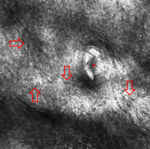 Imagem de microscopia confocal de reflectância de um caso de tinha negra revela estruturas lineares e hiperreflexivas finas na parte superior da epiderme (setas vermelhas; o asterisco indica um acrossiríngeo).