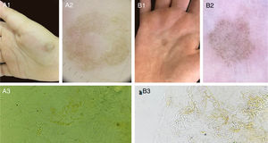 Dois casos de tinha negra apresentam aspecto clínico clássico (A1, B1). Dermatoscopia de ambos os casos, com estruturas lineares hipercrômicas curtas na epiderme (A2, B2). Exame micológico direto (KOH 20%), com hifas septadas demáceas curtas (A3 200×, B3 400×).