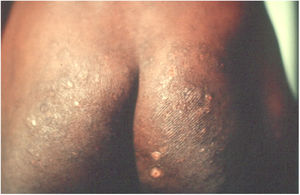 A, Oncocercose. Intenso prurido, presença de liquenificação, exulcerações e hiperpigmentação. Paciente da Clínica de Doenças Infecciosas de Ibadan, Nigeria. (Arquivo pessoal: Prof. Dr. Sinésio Talhari).