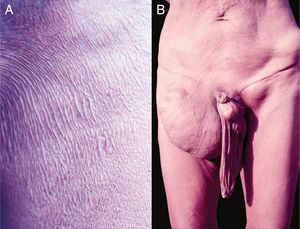 A. Oncocercose. Presença de áreas atróficas em pacientes com longa evolução. B. Oncocercose. Observar o aspecto clássico da “virilha caída” (conhecida como hanging groin) decorrente de longa evolução. Há, também, alongamento da bolsa escrotal (secundário à atrofia cutânea), nódulos na crista ilíaca e virilha esquerda – provavelmente, oncocercomas. (Arquivo pessoal: Prof. Sinésio Talhari). Indígena Yanomami.