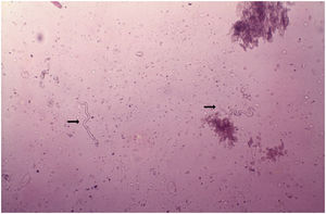 Oncocercose. Observar duas microfilárias (Onchocerca volvulus). Exame direto, em soro fisiológico. Aumento 40×. (Arquivo pessoal: Prof. Dr. Sinésio Talhari).