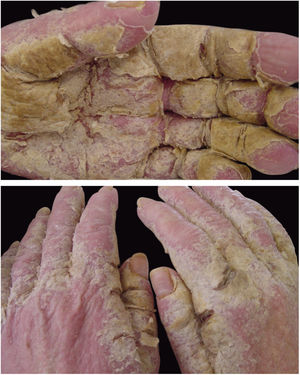 Sarna crostosa. Prurido intenso, constante, e lesões eritemato‐escamosas, generalizadas. HTLV+ paciente. Arquivo pessoal: Dr. Paulo Roberto Machado.