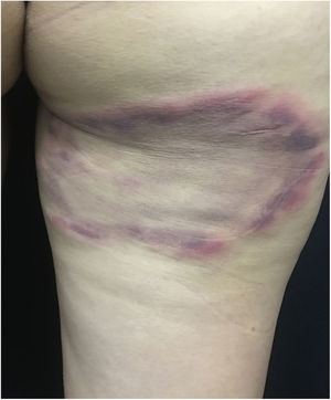 Doença de Lyme. Placa, apresenta crescimento centrífugo, com bordas eritemato‐violáceas, mede, aproximadamente, 18 cm, localizada na face posterior da coxa.