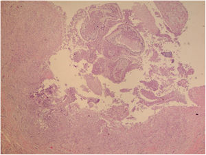 Presença de processo inflamatório granulomatoso com supuração e no meio os esporângios (Hematoxilina & eosina, 40×).