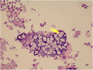 Presença de esporângios agrupados dentro do citoplasma dos macrófagos (Hematoxilina & eosina, 400×).