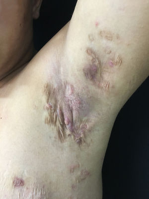 Lesões sugestivas de hidradenite supurativa na axila: nódulos, cicatrizes e traves de fibrose.