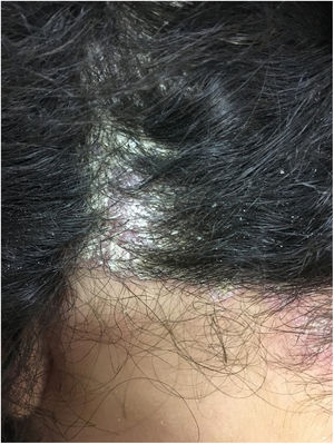 Lesões eritematoescamosas no couro cabeludo sugestivas de psoríase.