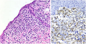A imagem à esquerda, corada pelo HE, apresenta numerosos mastócitos dispostos difusamente na derme. À direita, a reação imuno‐histoquímica CD117 (c‐kit) é difusamente positiva nos mastócitos.