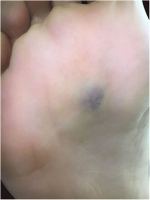 Mancha de coloração violácea, com limites mal definidos, na planta do pé direito.