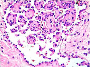 Histopatologia. Maior aumento mostra células arredondadas e hipercromáticas que se projetam para o lúmen – “células em tachão” (Hematoxilina & eosina, 400×).
