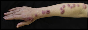 Foto clínica antes do tratamento com terbinafina. Nódulos de aproximadamente 2cm de diâmetro, discretamente eritematosos, que seguiam o trajeto de drenagem linfática do membro superior direito. Em algumas lesões havia formação de úlceras centrais.
