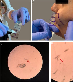 O exame microscópico dos ácaros foi feito por biópsia padronizada de superfície da pele (BPSP) com cola de cianoacrilato nos grupos de pacientes e controles. (a) Preparação da lâmina com cola de cianoacrilato; (b) Coleta da amostra na bochecha; (c e d) Exame microscópico dos ácaros Demodex (40×).
