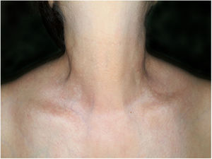 Pápulas esbranquiçadas no pescoço e fossas supraclaviculares.