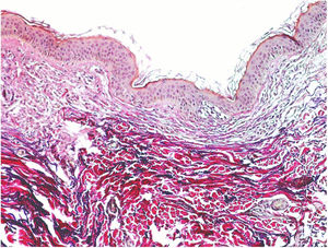 Quantidade reduzida de fibras elásticas na derme papilar (van Gieson, 200×).