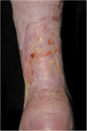 Úlcera venosa cicatrizada, apresenta apenas algumas áreas exulceradas e hiperceratóticas.
