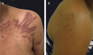 Dermatite flagelada associada ao tratamento com bleomicina: (A) placas lineares eritematosas pruriginosas, (B) seguidas de pigmentação linear.
