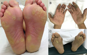 Reação mão‐pé associada a agentes antiangiogênicos (VEGFRi): (A) lesões hiperqueratósicas (sorafenibe) e (B) lesões bolhosas (axitinibe) em áreas de pressão e fricção.
