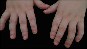 Mãos do paciente com 3 anos, mostrando linhas de Beau em quase todas as unhas e onicomadese nos segundos quirodáctilos (bilateralmente) e quarto quirodáctilo esquerdo.