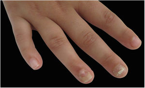 Mão direita da paciente com 7 anos, mostra onicomadese em terceiro e quarto quirodáctilos.