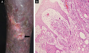 (A) Úlcera biopsiada. (B) O exame histopatológico mostrou hiperceratose, acantose, fibroplasia do colágeno, neovascularização e infiltrado inflamatório difuso composto de linfócitos, células epitelioides, células gigantes e histiócitos com hemossiderina (Hematoxilina & eosina, 100×).