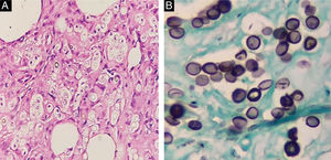 (A) Estruturas arredondadas foram evidenciadas na derme reticular (Hematoxilina & eosina, 200×). (B) A coloração por Groccott mostrou numerosas leveduras arredondadas com membrana dupla, isoladas ou em cadeia, ligadas por projeções tubulares (Groccott, 400×).
