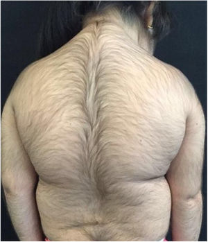 Hipertricose no dorso e membros superiores.