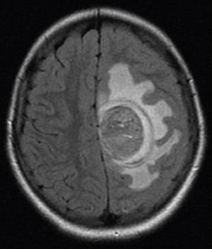 Lesão única expansiva sólida que media 5×3,5 cm em região frontoparietal esquerda, associada a intenso edema vasogênico, promoviam desvio da linha média.
