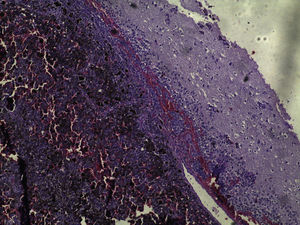 Neoplasia formada pela proliferação de células atípicas com pigmento, infiltrava preferencialmente a meninge, em meio a áreas de necrose e de hemorragia (Hematoxina & eosina, 40×).